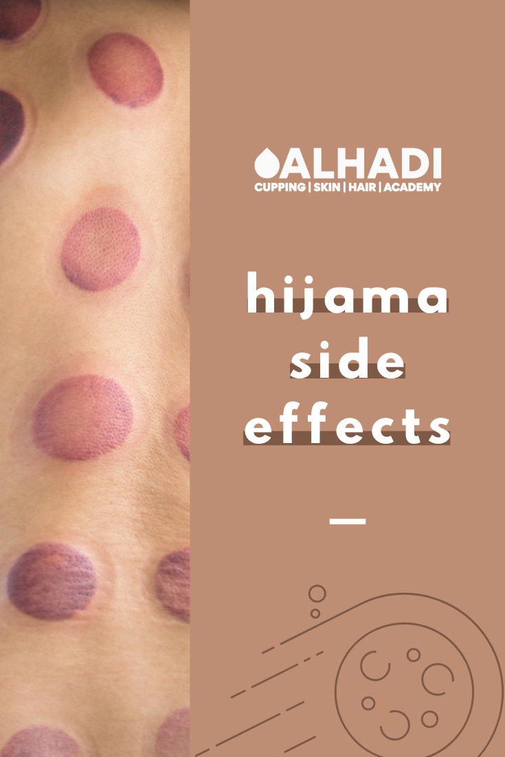 Cupping marks explained in detail -haad al hijama in hyderabad